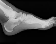 Foot Xray at our chiropody clinic at Brook Green Clinic Hammersmith